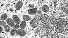 Opičí neštovice neboli monkeypox je virové onemocnění, které se podobá pravým... | na serveru Lidovky.cz | aktuální zprávy