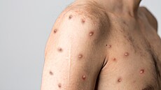 Opičí neštovice neboli monkeypox je virové onemocnění, které se podobá pravým... | na serveru Lidovky.cz | aktuální zprávy