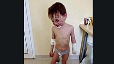 Ukrajinský chlapec, který piel o ruku pi ruském bombardování.