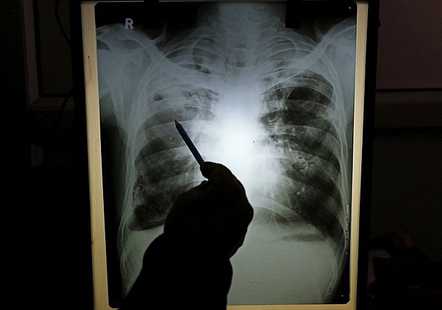 Tuberkulóza se v Libavé nešíří. Je to dezinformace, vyvrací hygienici
