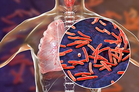 Tuberkulóza je nakalivá infekce, která se íí vzduchem (kdy nakaený kale)....