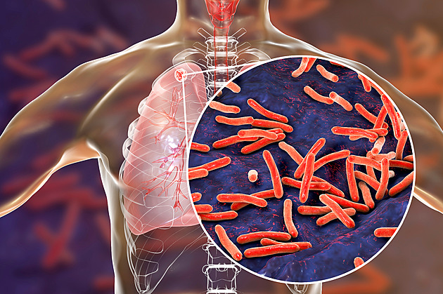 Na pokraji epidemie. Případy černého kašle rekordně rostou, přibývá i záškrtu