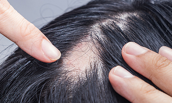 Alopecia areata způsobuje ložiskové vypadávání vlasů.