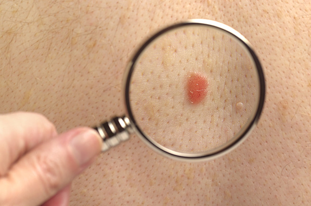 I nehojící se vřed může být rakovina kůže, upozornila lékařka