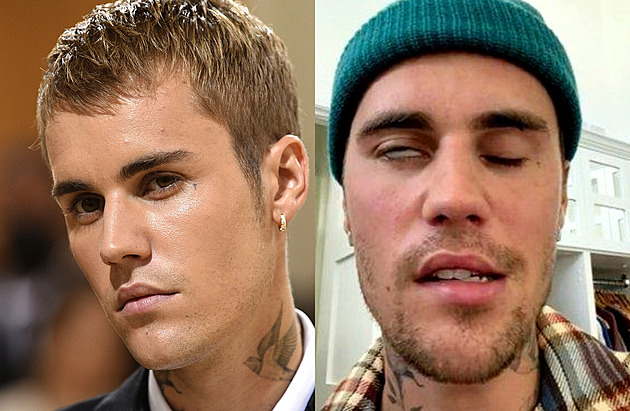 Justin Bieber má ochrnutou polovinu obličeje, může za to zákeřný virus