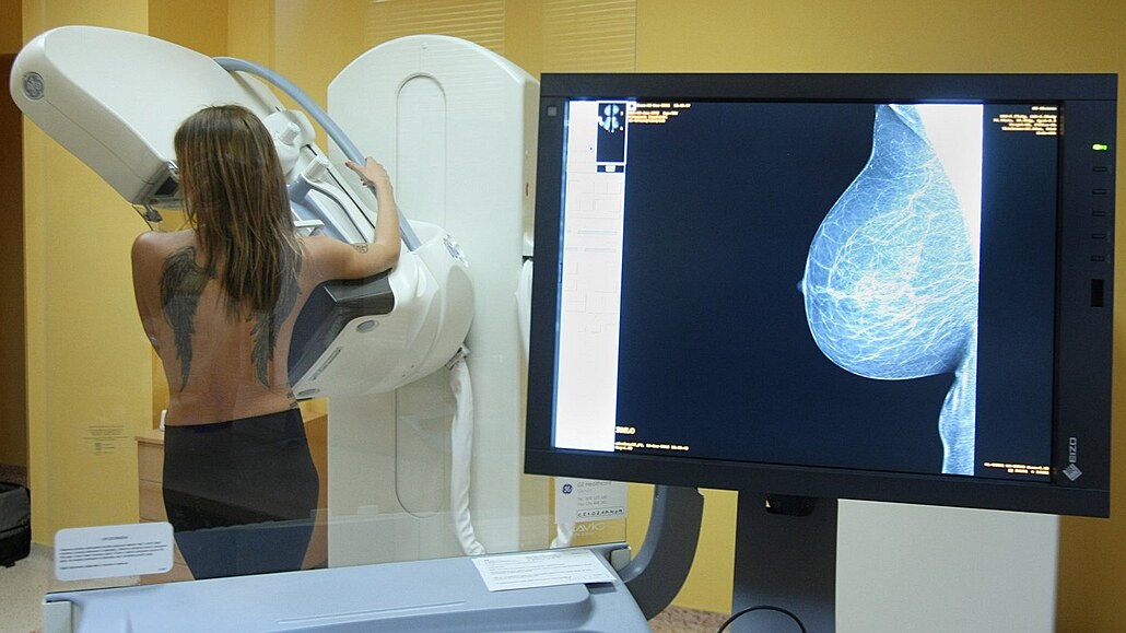 Vyetení prsu na mamografu - ilustraní foto.