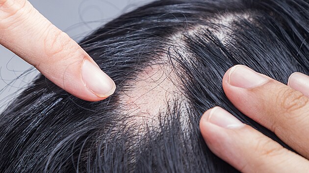 Alopecia areata zpsobuje loiskov vypadvn vlas.