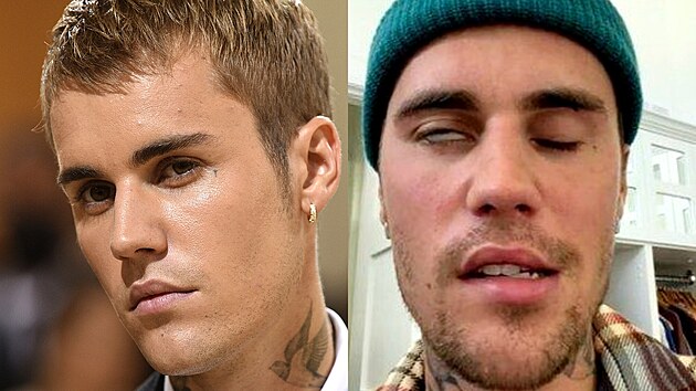 Justin Bieber m ochrnutou polovinu oblieje (10. ervna 2022)