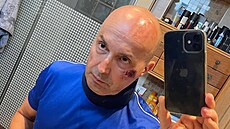 Tomái Hájkovi zstaly po nehod odeniny na oblieji a otisky helmy na temeni.