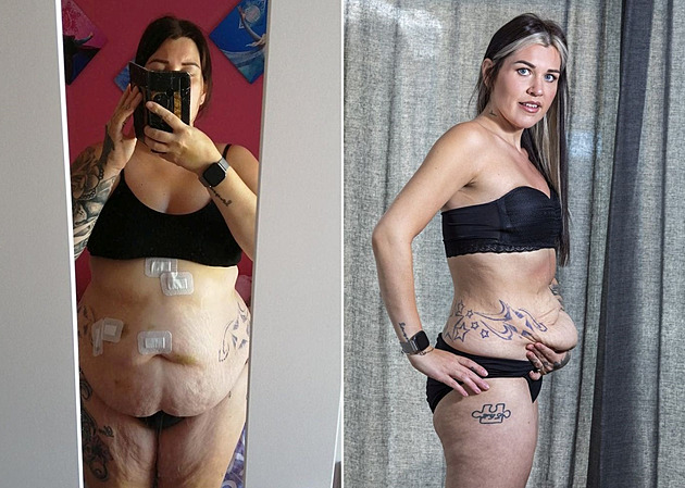 Vážila sto jedenáct kilo, díky operaci žena zhubla na osmašedesát