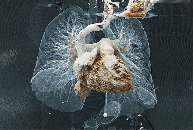 Plicní embolie, tepny břicha, srdce. Snímky z nového CT vyrazily dech i lékařům
