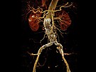 CT angiografie bicha - Stentgraf v biní aort (cévní protéza v srdenici)