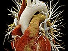 CT angiografie srdce a hrudní aorty  pohled zpedu