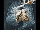 CT angiografie srdce a plic  Plicní embolie