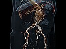 CT angiografie bicha  aneurysma (výdu) biní aorty, kalcifikace ve stn...