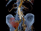 CT angiografie bicha  stentgraft (cévní protéza), transplantovaná ledvina,...