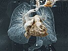 CT angiografie srdce a plic  Plicní embolie