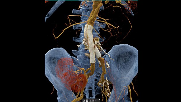CT angiografie bicha  stentgraft (cvn protza), transplantovan ledvina, uzaven ilikofemorln bypass (pemostn uzavenho seku na tepn)