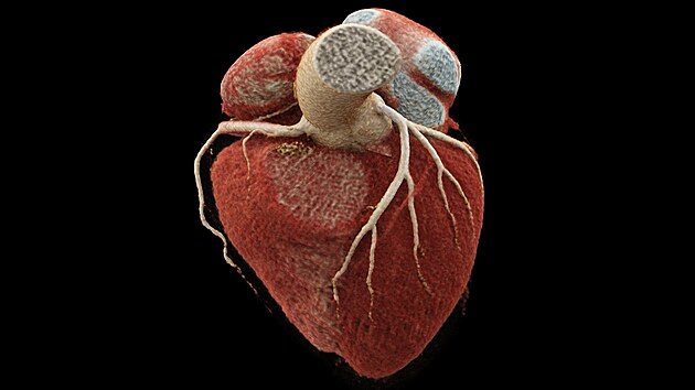 Zobrazen koronrnch tepen pomoc CT pstroje (tzv. CT angiografie)  zdrav srdce