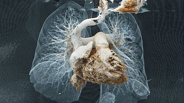 CT angiografie srdce a plic  Plicn embolie