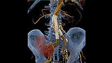 CT angiografie bicha  stentgraft (cévní protéza), transplantovaná ledvina,...