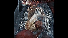 CT angiografie plicnice  embolie (ucpání krevní sraeninou) levé horní vtve