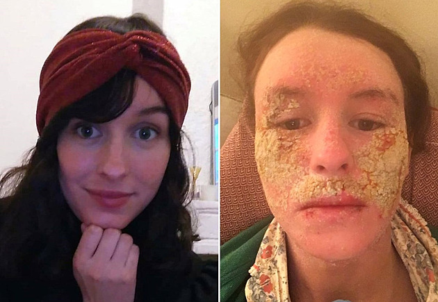 Žena strávila měsíc doma, aby nikdo neviděl její zohyzděný obličej