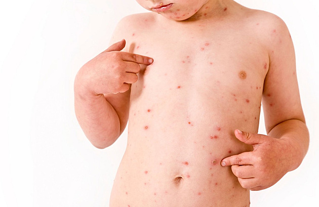 Plané neštovice nehrozí jen dětem. V dospělosti mohou být nebezpečné