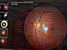 Um�l� inteligence odhal� diabetickou retinopatii, kter� b�v� ve vysp�l�ch...