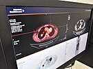 Krajsk nemocnice T. Bati ve Zln vyuv nejnovj verzi SPECT/CT, jde o...