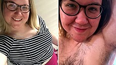 Leah má nadměrné ochlupení po celém těle.