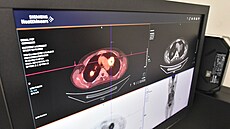 Krajská nemocnice T. Bati ve Zlín vyuívá nejnovjí verzi SPECT/CT, jde o jeden z nejlépe vybavených pístroj v eské republice. Pro jeho obsluhu jsou poteba radiologití asistenti.