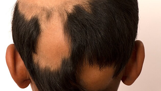 Lysiny na hlav mladho mue zpsobilo onemocnn alopecie areata.