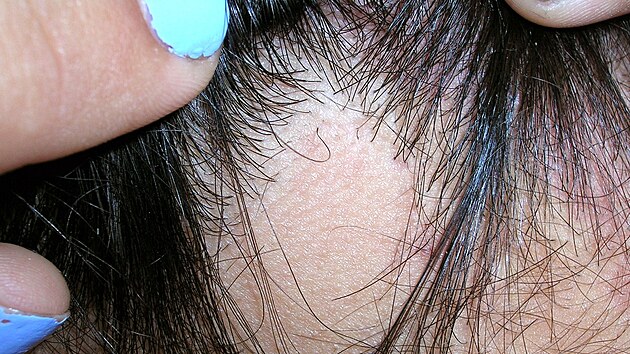 ena s nemoc alopecie areata.