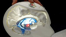 Intracerebrální optické za�ízení CEA-Leti ur�ené ke zpomalení Parkinsonovy...
