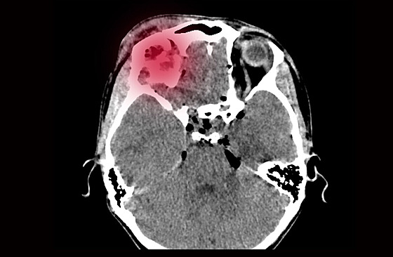 Snímek mozku pacienta s cévní mozkovou mrtvicí