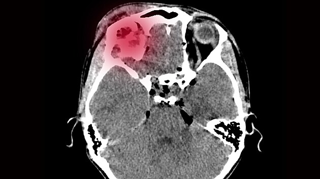 Snímek mozku pacienta s cévní mozkovou mrtvicí