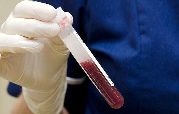 Krevní testy mi zachránily život. Rakovina prostaty se odhalila včas