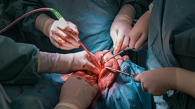 Lkai z Oddlen stn, elistn a obliejov chirurgie v Baov nemocnici ve Zln pi operaci nahradili pacientovi st elistn kosti implanttem vyrobenm na 3D tiskrn. (nor 2023)