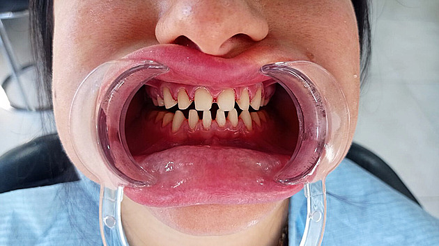 Obroušené zuby a na nich zářivě bílé korunky. Zubaři se děsí nového trendu