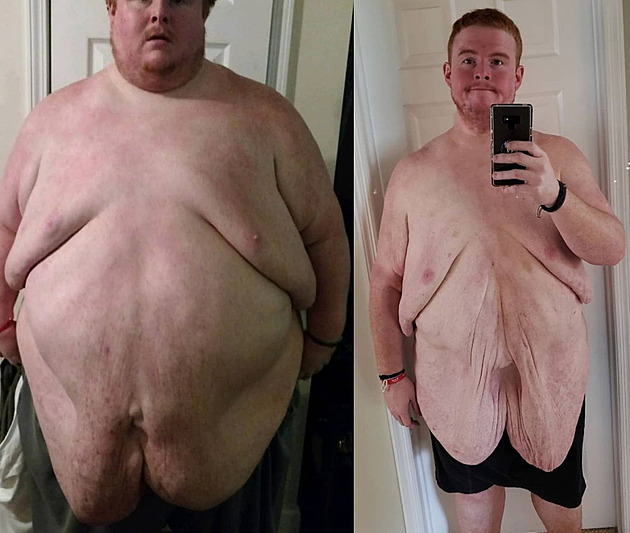 Muž zhubl dvě stě šedesát kilogramů, kvůli obezitě nemohl projít dveřmi