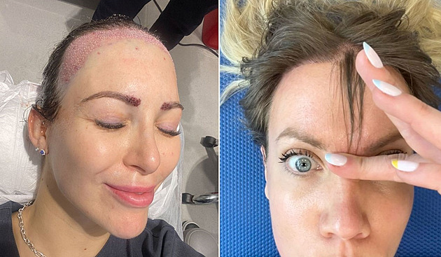 Žena se roky trápila kvůli vysokému čelu, pomohla transplantace vlasů