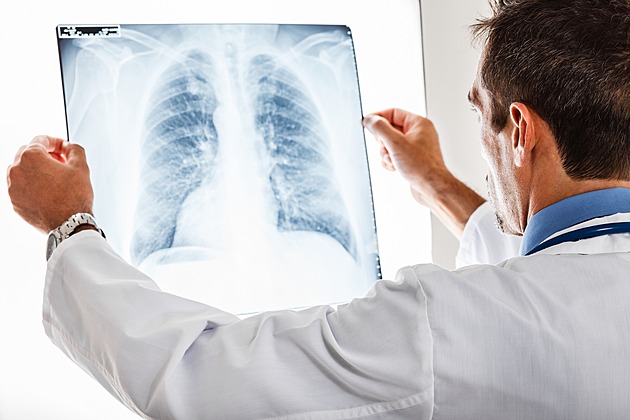 V Česku přibývají případy odolné formy tuberkulózy. Nemocnicím chybějí lůžka
