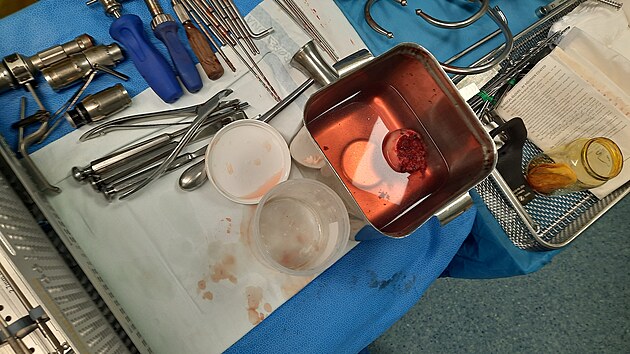 Implantace kostní tkáně pacientovi po úraze ve znojemské nemocnici.