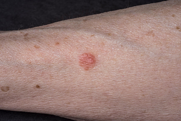 Červené skvrny na kůži vystavené slunci mohou znamenat nádor, varuje lékař