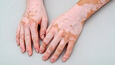 Vitiligo je neinfekní autoimunitní onemocnní zpsobující bílé skvrny na...
