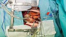 Na pístrojích lze nacviovat operaci srdce za rzných okolností, a to bez...