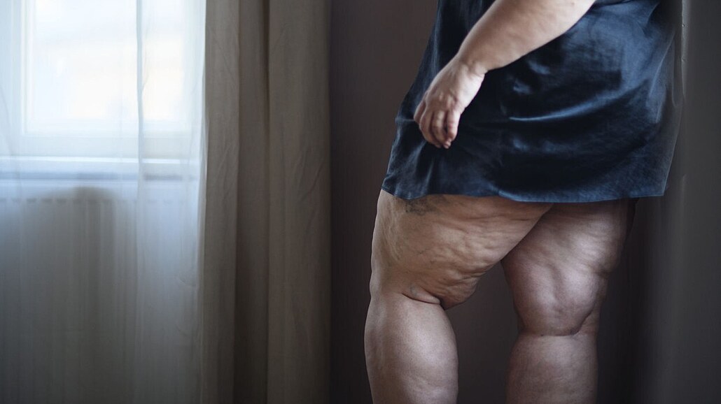 Snaha zhubnout stehna �asto nará�í na genetiku i hormonální nastavení. Gluteofemorální tuk v�ak pro t�lo funguje jako ochrana p�ed metabolickými poruchami.