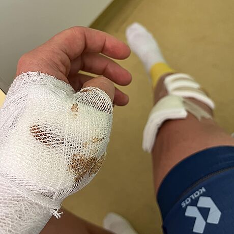 Zranný cyklista Jan Janák odnesl stet s vozidlem zlomenou klíní kostí,...