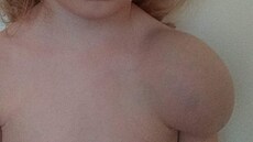 Boule na rameni Veroniky Tillové.